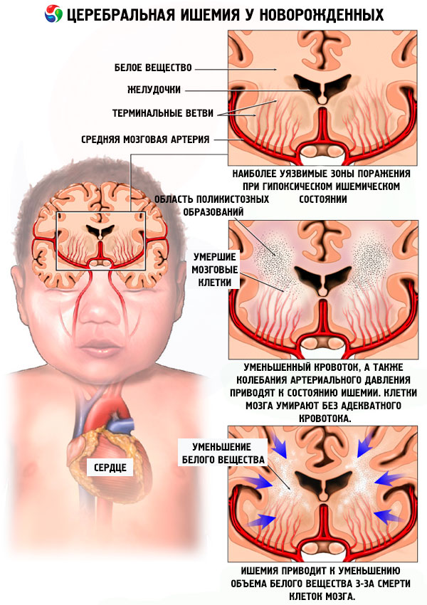 Синдромы при перинатальном поражении нервной системы